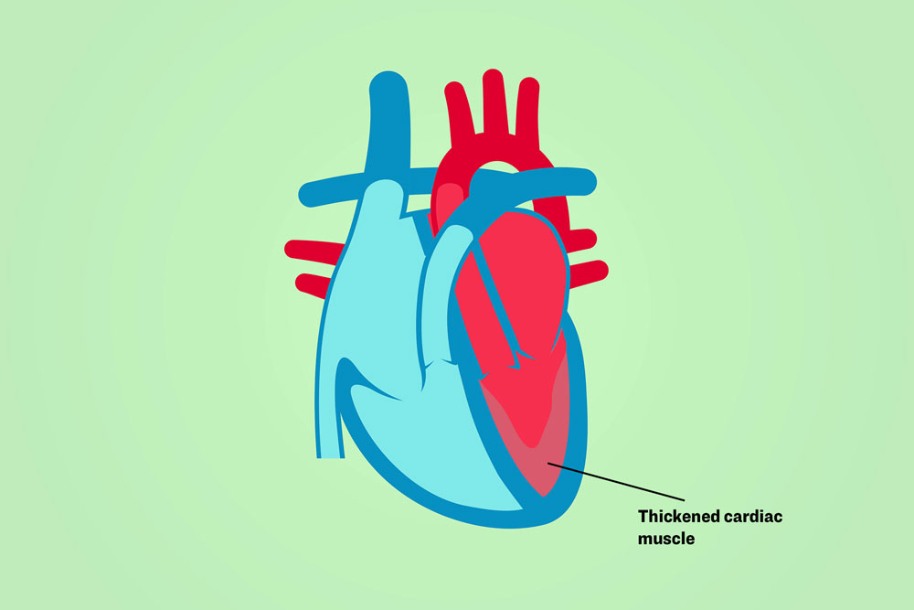 Illustration of a heart showing thickened cardiac muscle